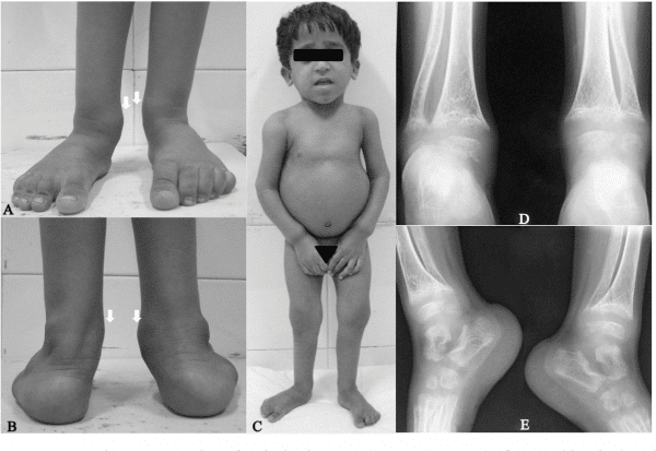 effects of vitamin D deficiency